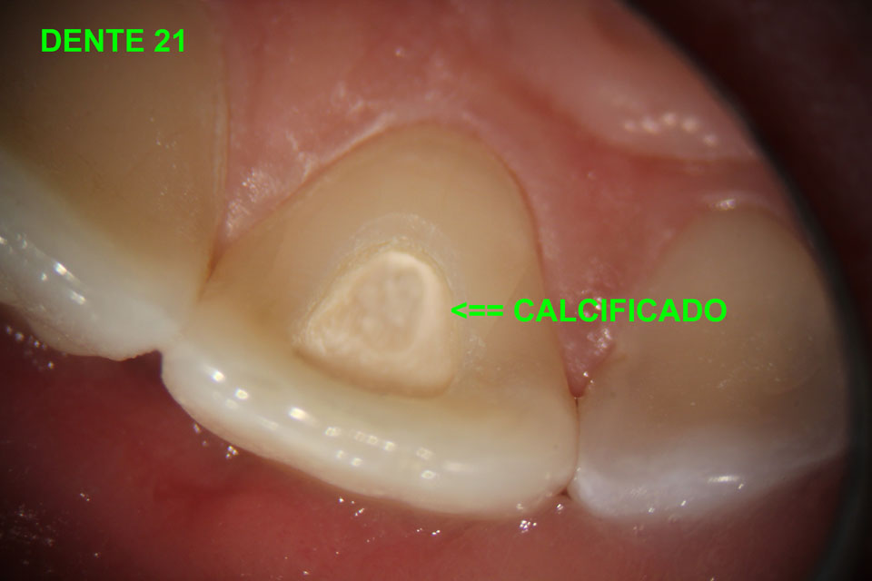 Canal Calcificado - Fenelon Endodontia