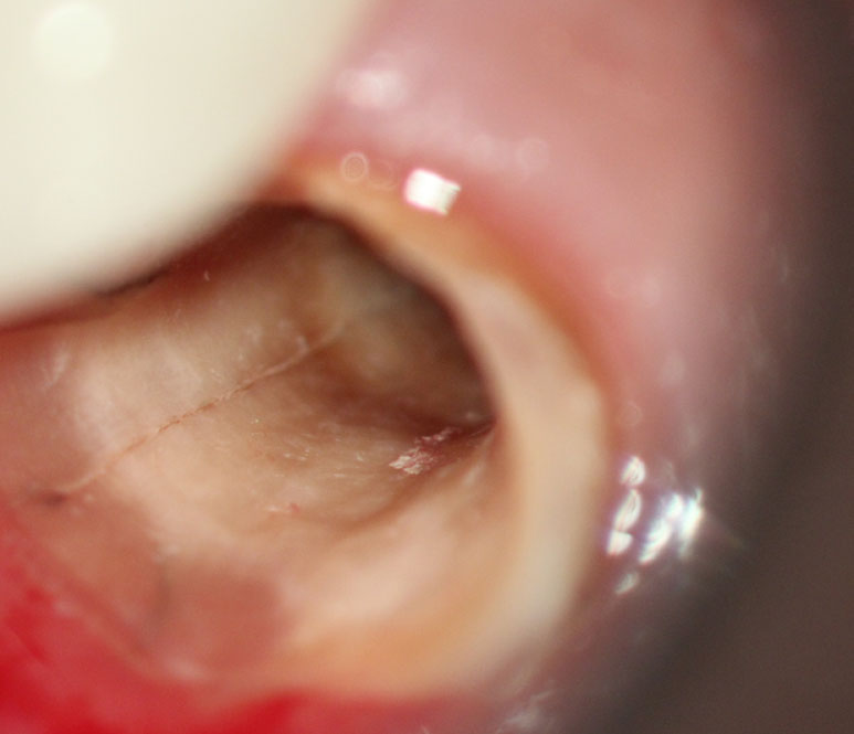 Diagnóstico de Fratura - Josias Fenelon Endodontia Microscópica Digital