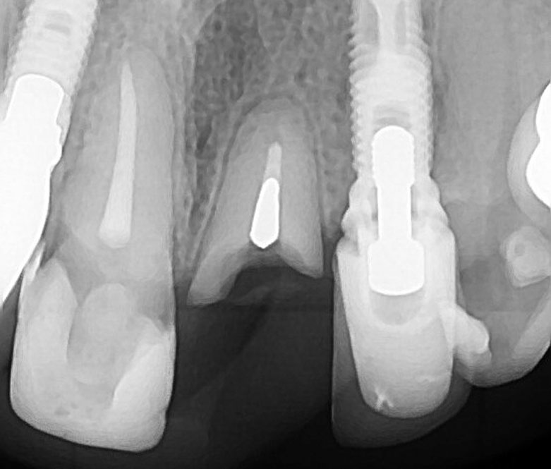 Remoção de instrumento fraturado - Josias Fenelon Endodontia Microscópica Digital