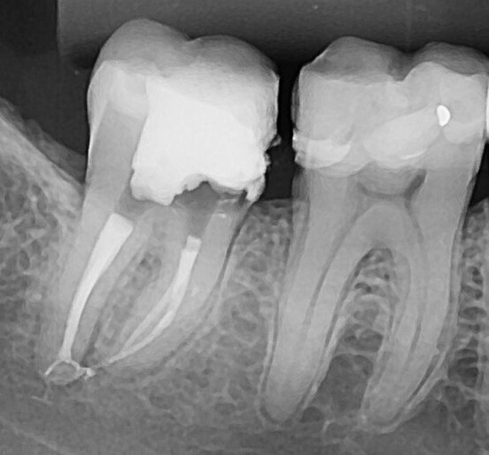 Tratamento de Canal - Josias Fenelon Endodontia Microscópica Digital