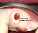 Tratamento de Perfuração - Josias Fenelon Endodontia Microscópica Digital