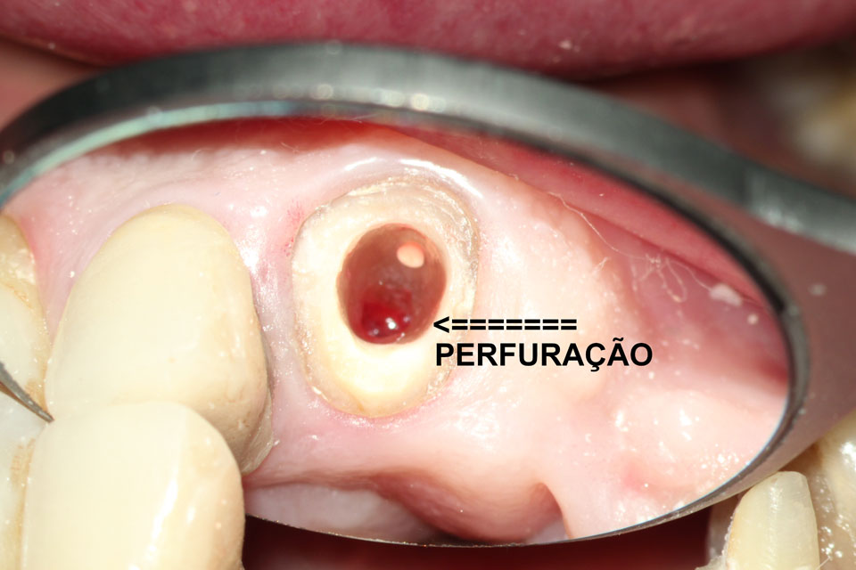 Tratamento de Perfuração - Josias Fenelon Endodontia Microscópica Digital