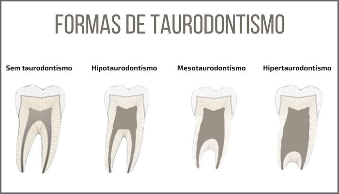 Formas de Taurodontismo - hipertaurodontismo, mesotaurodontismo e hipotaurodontismo